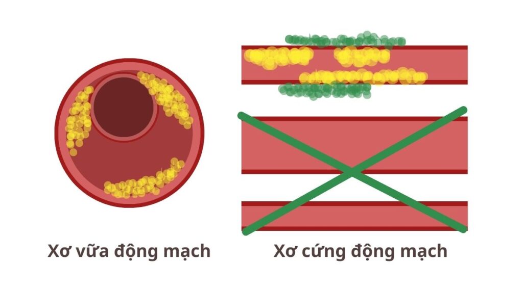 Dinh dưỡng chay chống lại chứng xơ vữa và xơ cứng động mạch