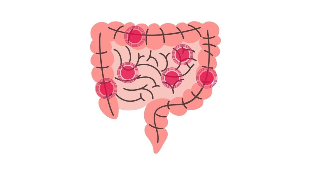 Bệnh Crohn và lợi ích của dinh dưỡng chay