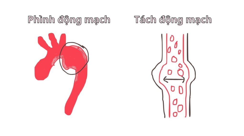Giảm nguy cơ chứng phình và tách động mạch với dinh dưỡng chay