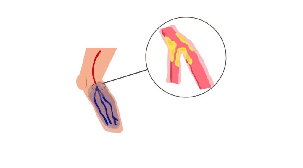 Giải thích thiếu máu cục bộ và lợi ích ăn chay