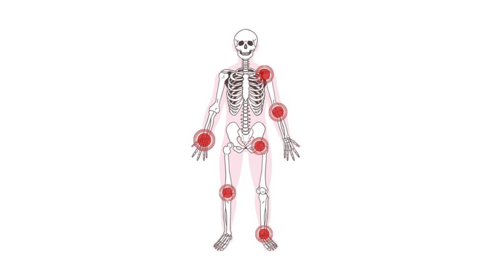 Lợi ích của dinh dưỡng chay với viêm khớp dạng thấp